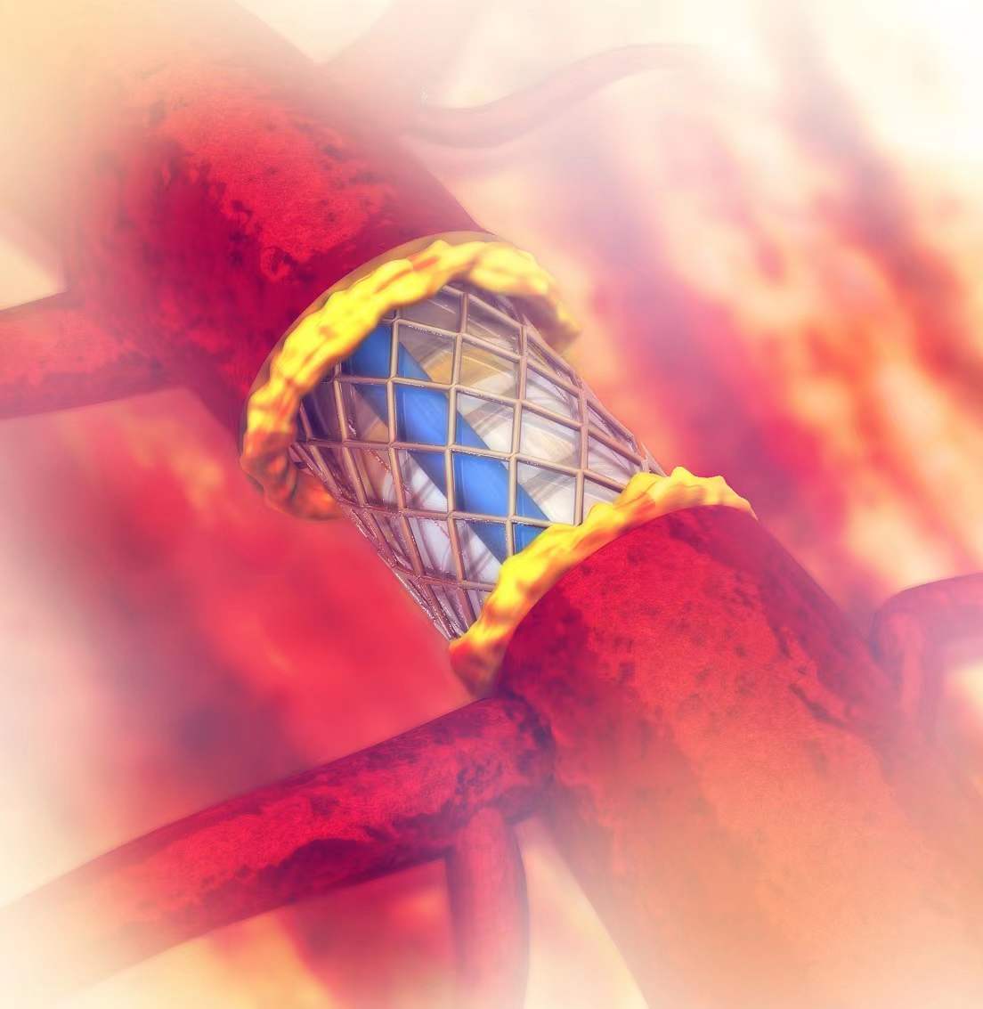 奧泰康服務于創(chuàng)新前沿-PartⅢ：外周血管（下）